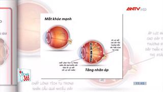 Điều trị sớm tăng nhãn áp Glocom để phòng tránh mù loà