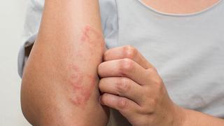 Gia tăng bệnh về da vào mùa hè