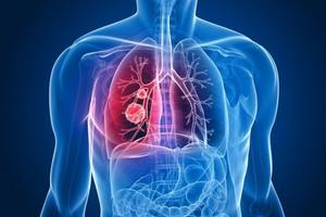 Biểu hiện của ung thư phổi