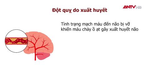 “Trẻ hoá” đột quỵ - Nỗi lo thời hiện đại