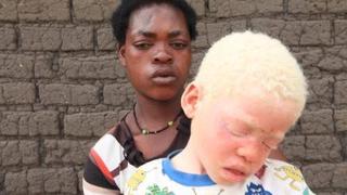 Cộng đồng hỗ trợ những người mắc bệnh bạch tạng tại Uganda