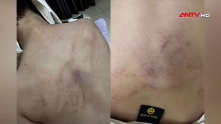 Đình chỉ thêm một giáo viên vụ bạo hành bé gái 4 tuổi