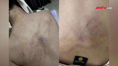 Đình chỉ thêm một giáo viên vụ bạo hành bé gái 4 tuổi
