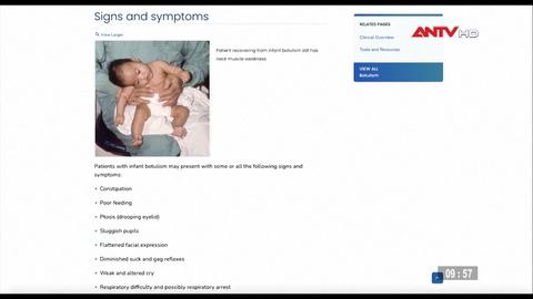 Số ca sơ sinh ngộ độc Botulinum tại Mỹ tiếp tục tăng