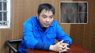 Cảnh báo từ vụ đục xương chân để trục lợi bảo hiểm