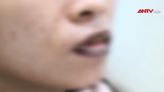 Làm đẹp cấp tốc đón Tết - lợi bất cập hại