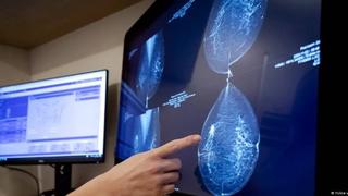 Sàng lọc AI giúp giảm các ca ung thư vú ác tính