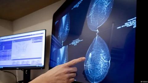 Sàng lọc AI giúp giảm các ca ung thư vú ác tính