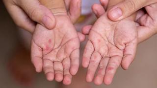 Cảnh báo bệnh tay chân miệng gia tăng do chủng virus EV71