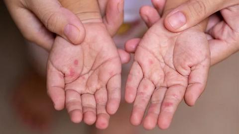 Cảnh báo bệnh tay chân miệng gia tăng do chủng virus EV71