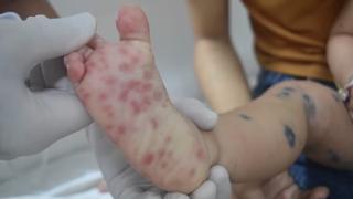 Kịp thời cứu chữa 2 trẻ nguy kịch do chủng virus EV71 bệnh tay chân miệng