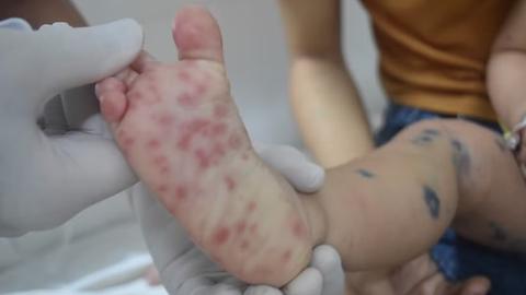 Kịp thời cứu chữa 2 trẻ nguy kịch do chủng virus EV71 bệnh tay chân miệng