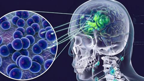 Cẩn trọng với viêm não mô cầu