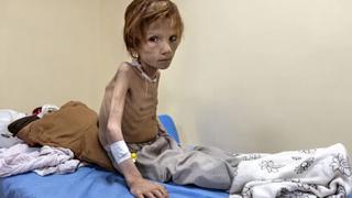 Tình trạng suy dinh dưỡng tại Afghanistan