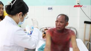  Dị ứng thuốc nhỏ mắt, một bệnh nhân suýt tử vong